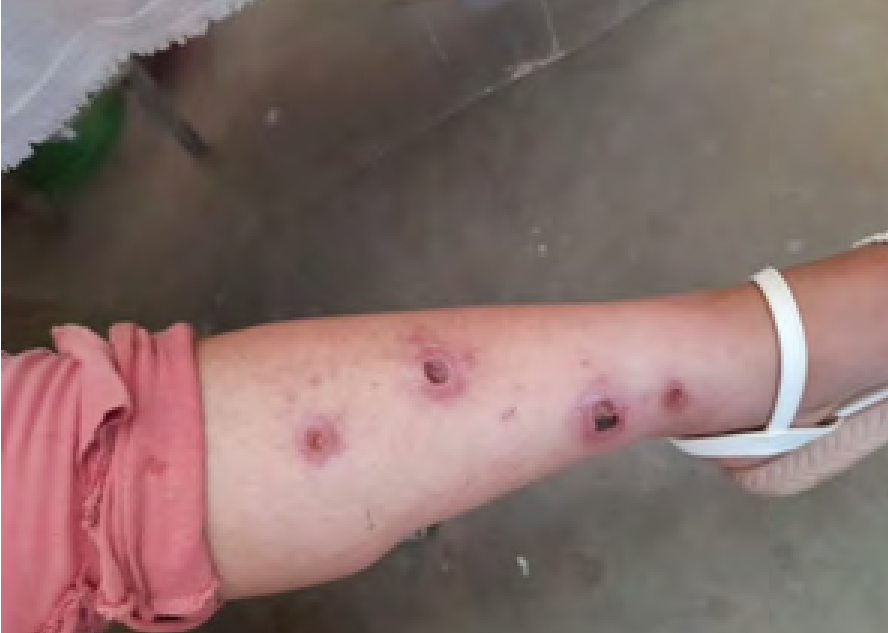 Figura-4-Lesiones-de-leishmaniasis-despues-del-segundo-tratamiento-con-medicina
